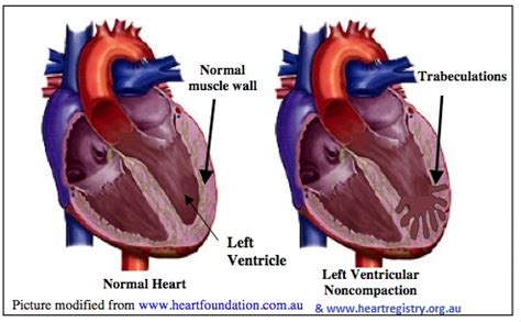 noncompaction cardiomyopathy life expectancy